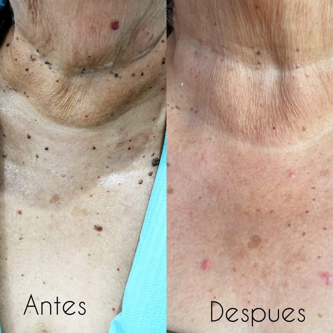 Antes y despues crema anti verrugas